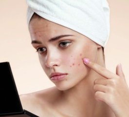 How Benzoyl Peroxide Can Help Treat Pimples